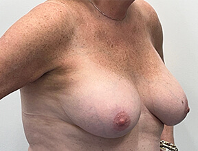 Breast Reduction - Before